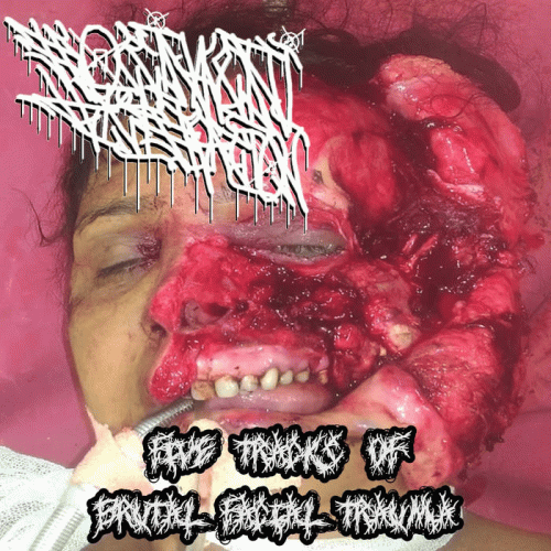 Five Tracks of Brutal Facial Trauma